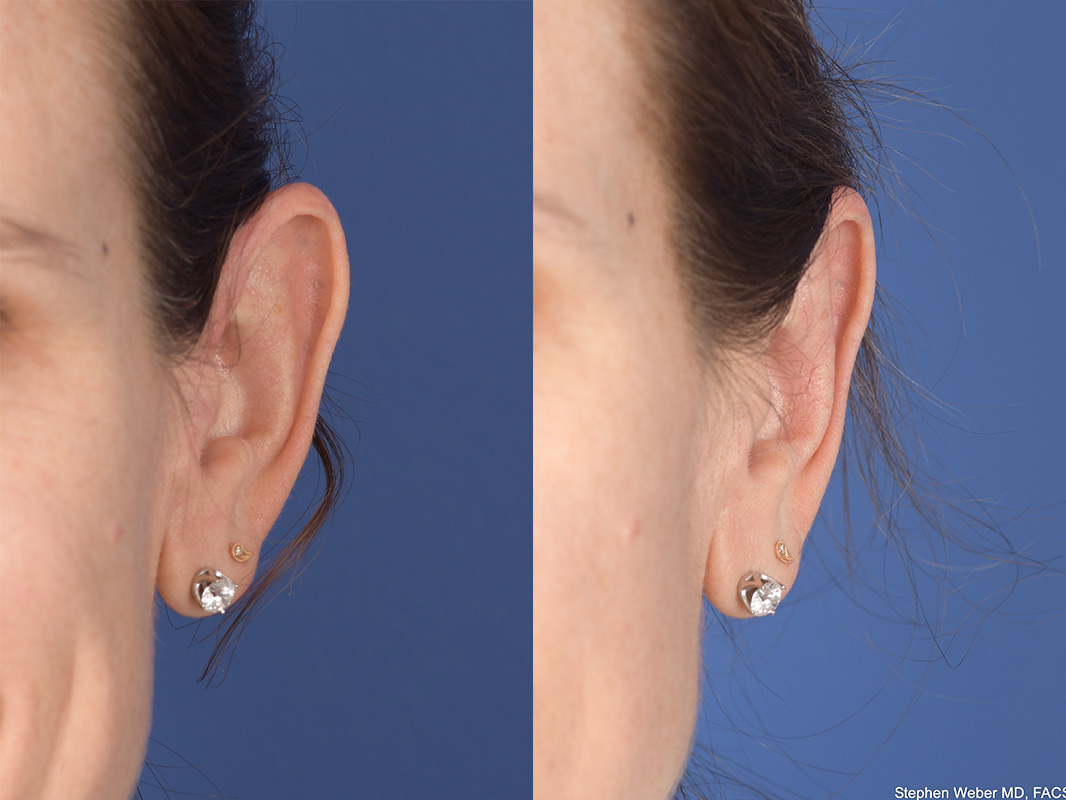 Otoplasty Before and After | Weber Facial Plastic Surgery