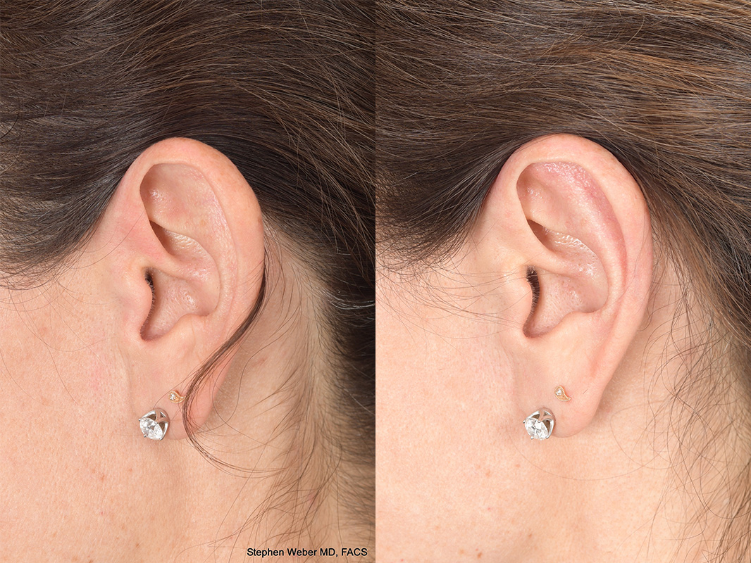 Otoplasty Before and After | Weber Facial Plastic Surgery