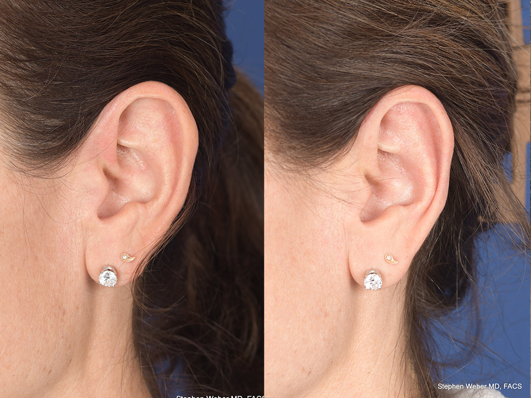 Otoplasty Before and After | Weber Facial Plastic Surgery