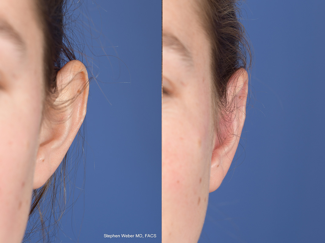 Otoplasty Before and After | Weber Facial Plastic Surgery