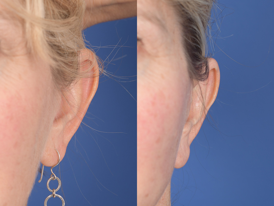 Otoplasty Before and After | Weber Facial Plastic Surgery