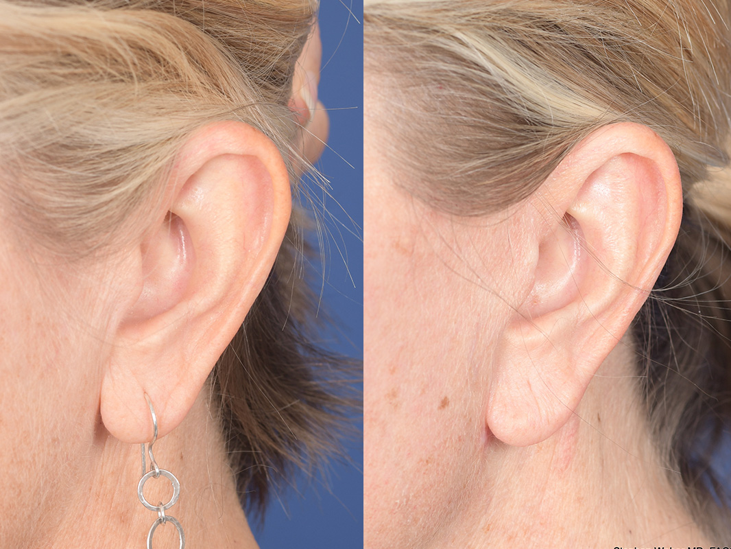 Otoplasty Before and After | Weber Facial Plastic Surgery