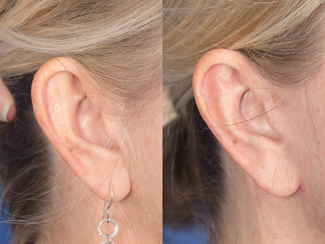 Otoplasty Before and After | Weber Facial Plastic Surgery