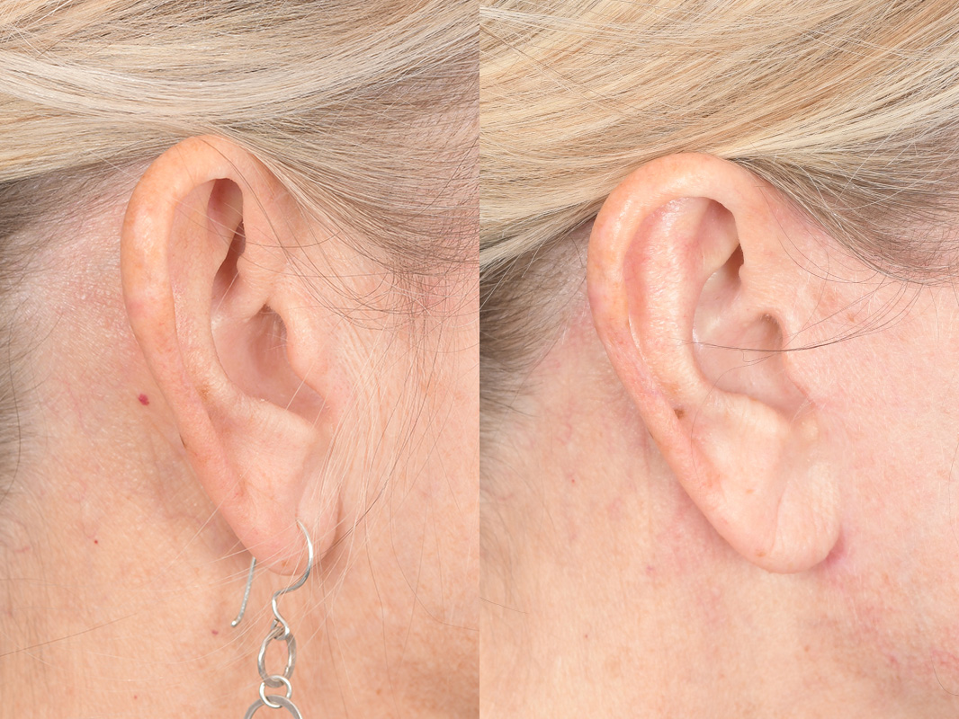 Otoplasty Before and After | Weber Facial Plastic Surgery