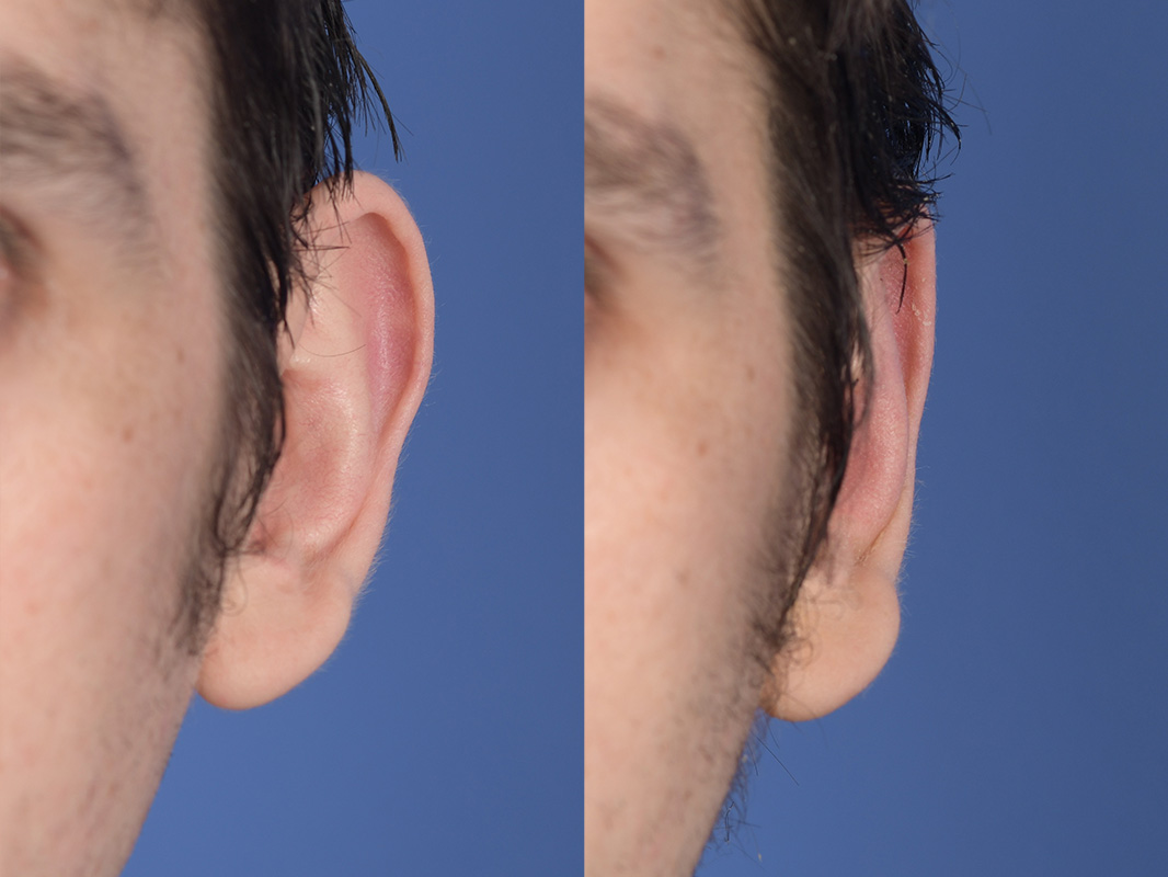 Otoplasty Before and After | Weber Facial Plastic Surgery