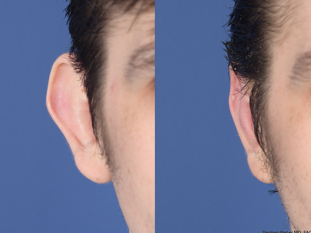 Otoplasty Before and After | Weber Facial Plastic Surgery