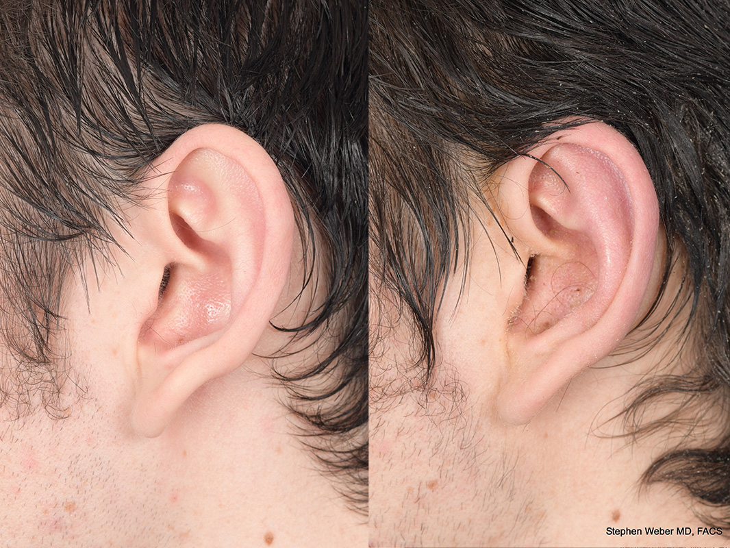 Otoplasty Before and After | Weber Facial Plastic Surgery