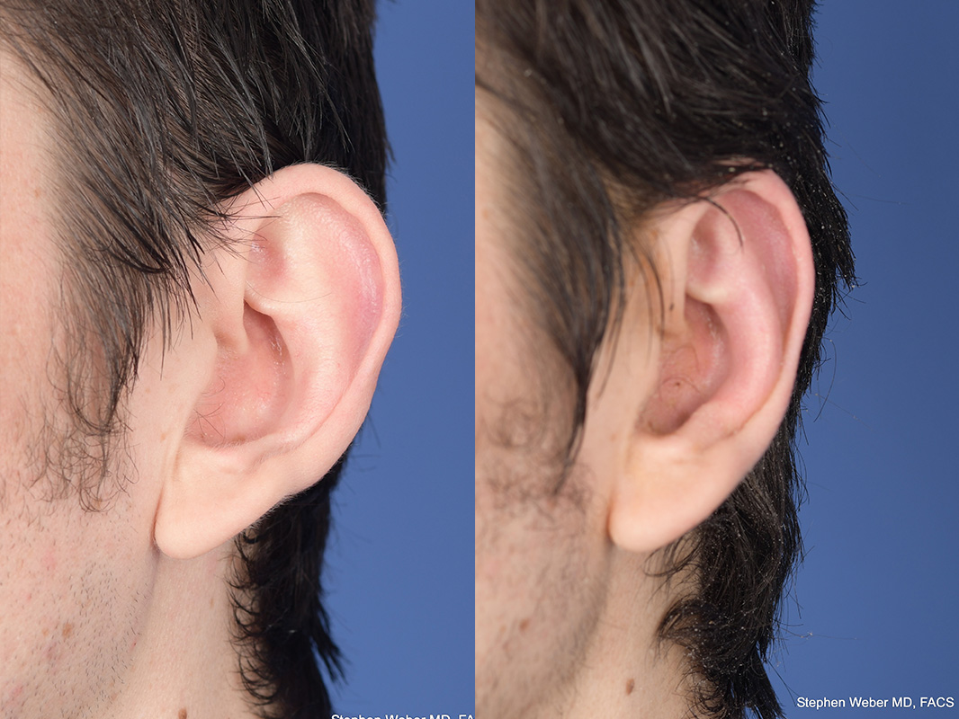 Otoplasty Before and After | Weber Facial Plastic Surgery