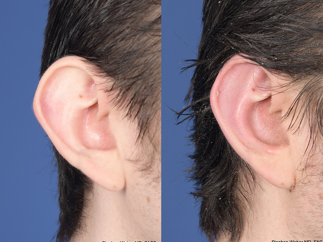 Otoplasty Before and After | Weber Facial Plastic Surgery