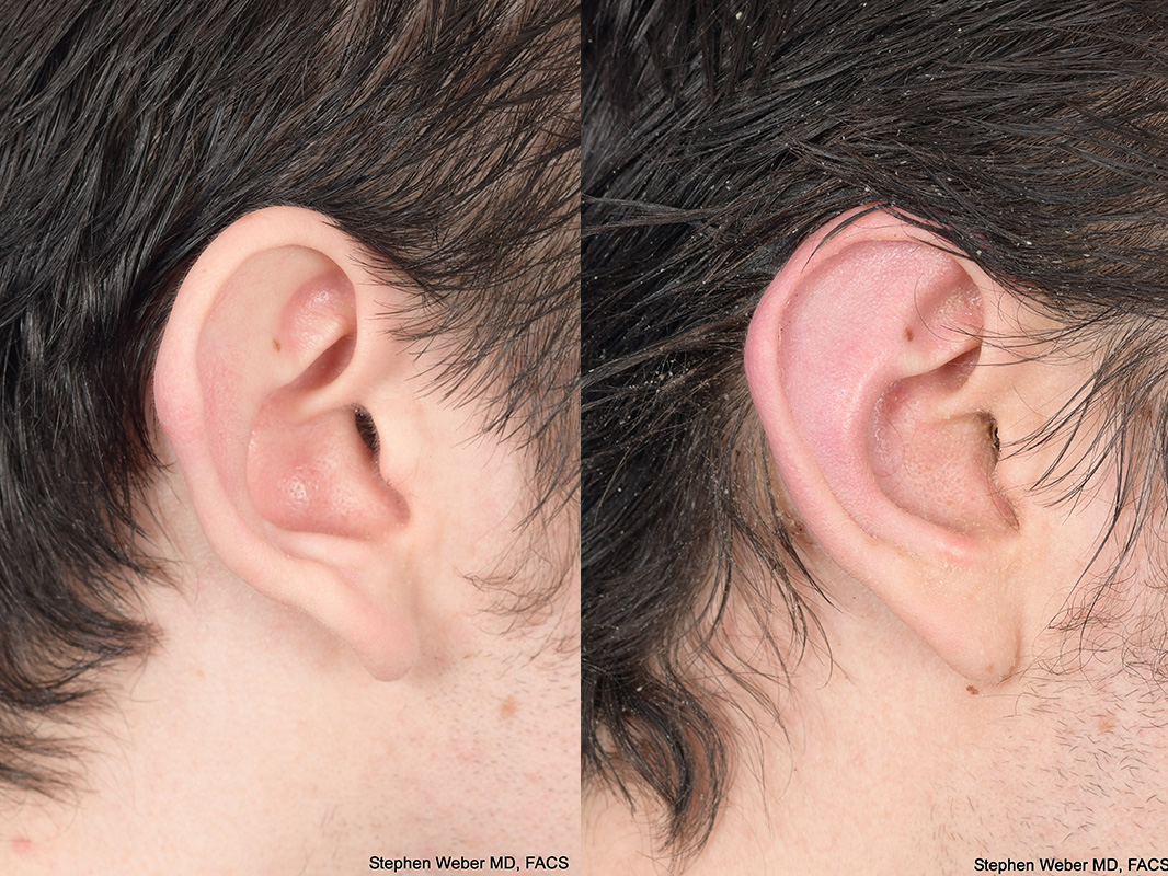 Otoplasty Before and After | Weber Facial Plastic Surgery
