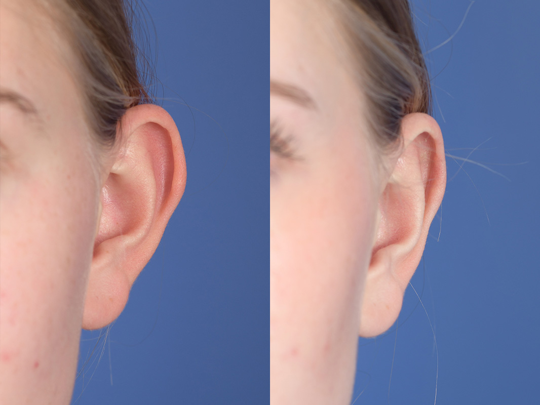 Otoplasty Before and After | Weber Facial Plastic Surgery