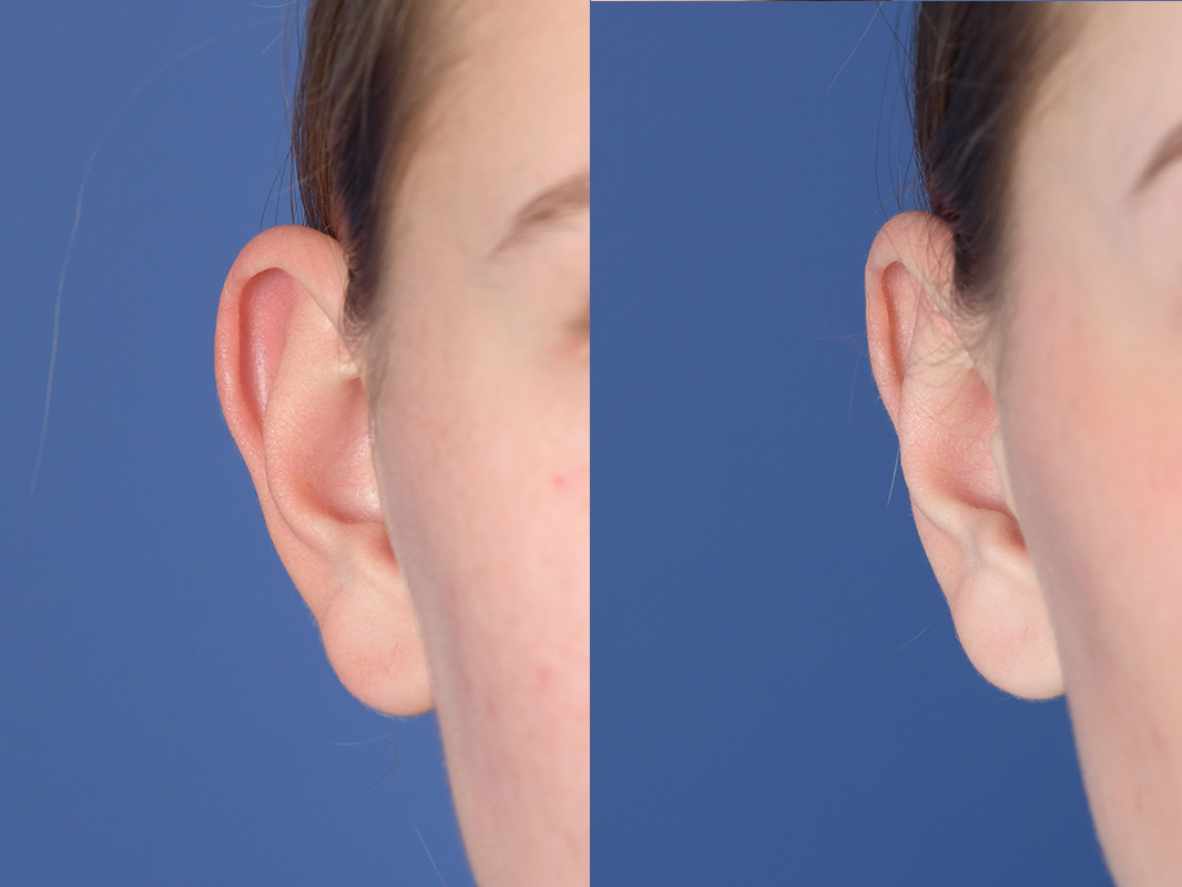 Otoplasty Before and After | Weber Facial Plastic Surgery