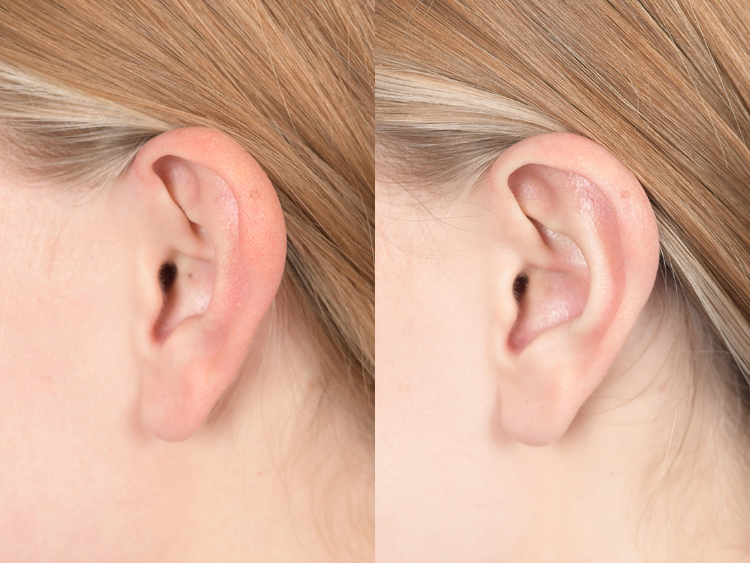 Otoplasty Before and After | Weber Facial Plastic Surgery