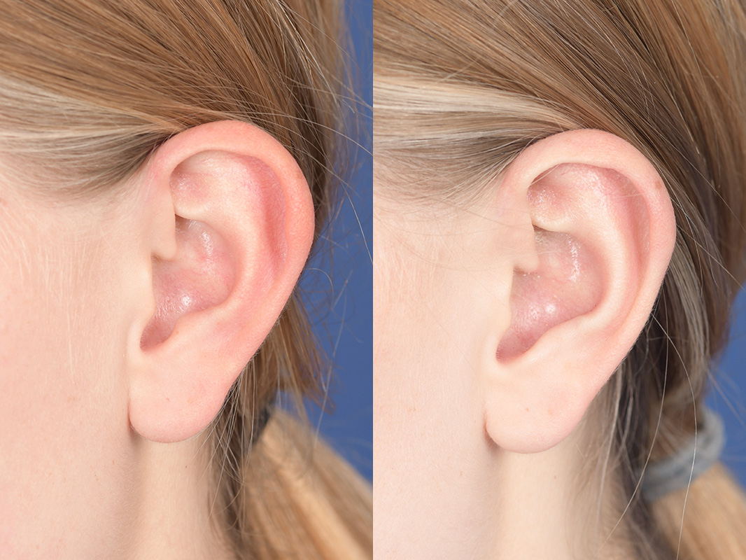 Otoplasty Before and After | Weber Facial Plastic Surgery