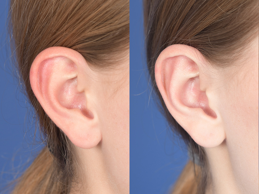 Otoplasty Before and After | Weber Facial Plastic Surgery