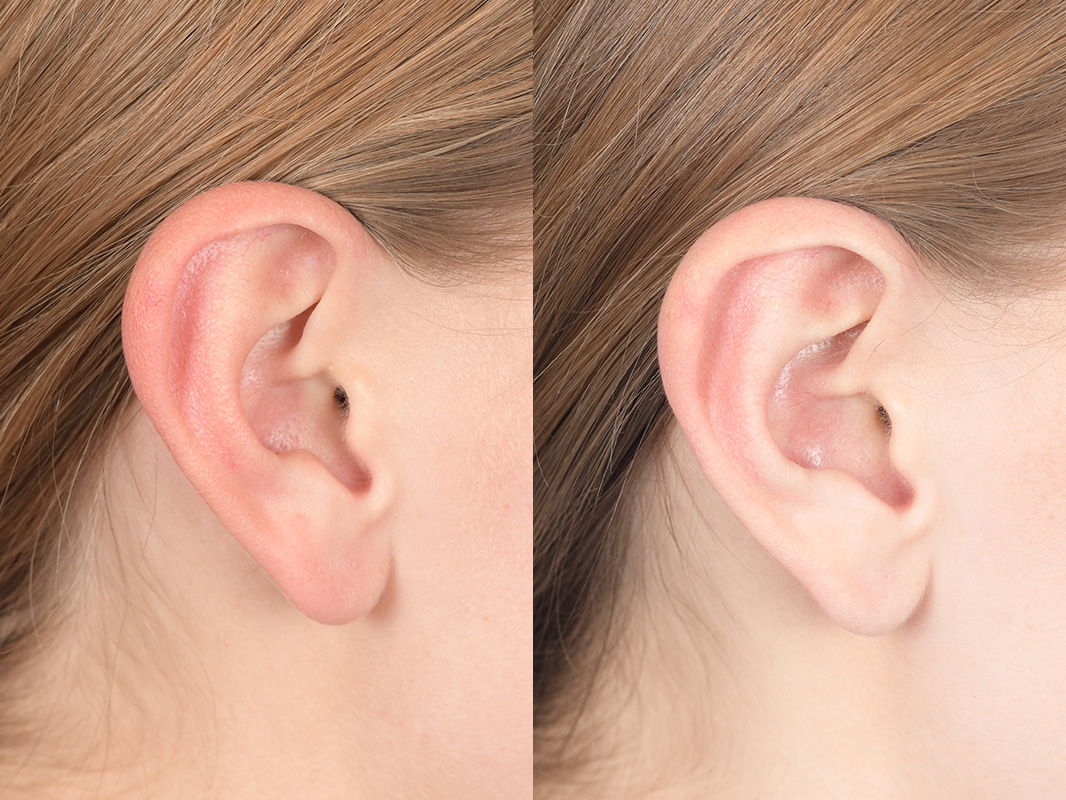 Otoplasty Before and After | Weber Facial Plastic Surgery