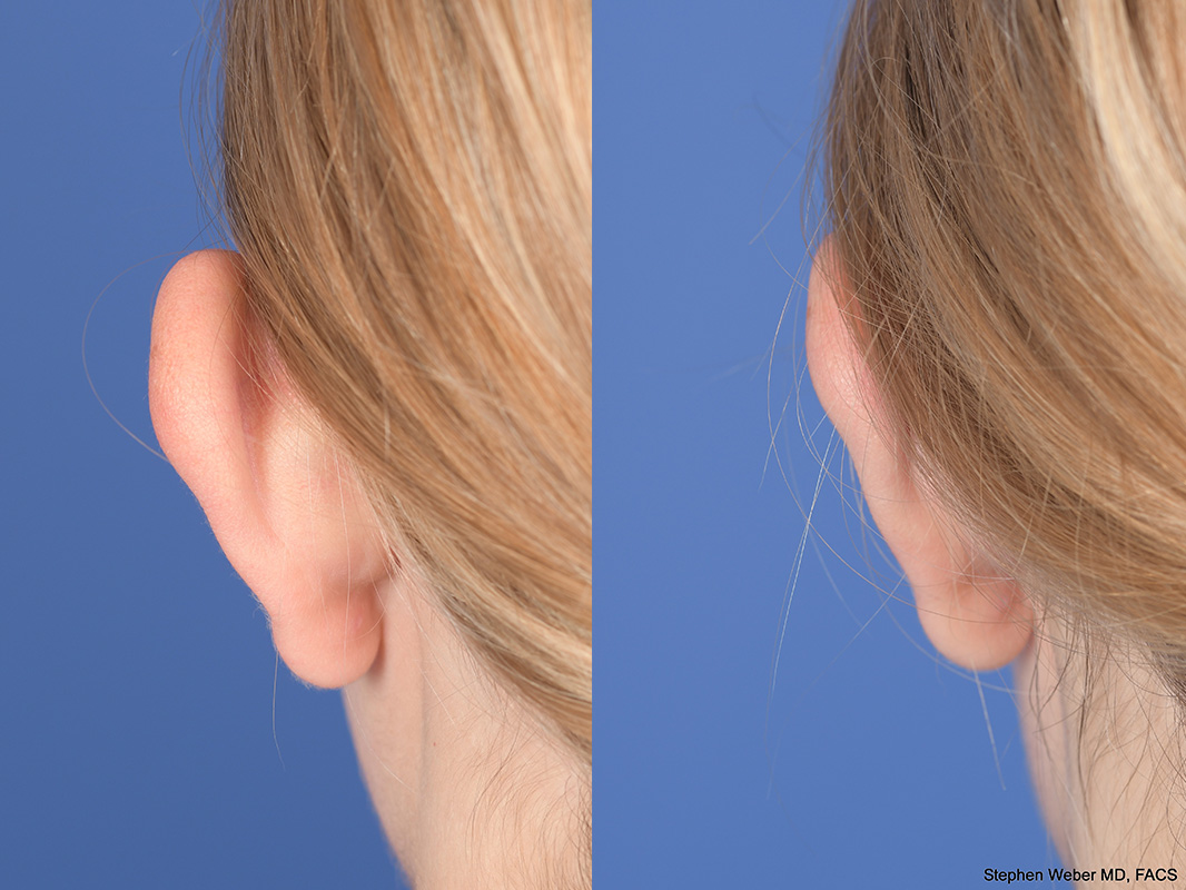 Otoplasty Before and After | Weber Facial Plastic Surgery