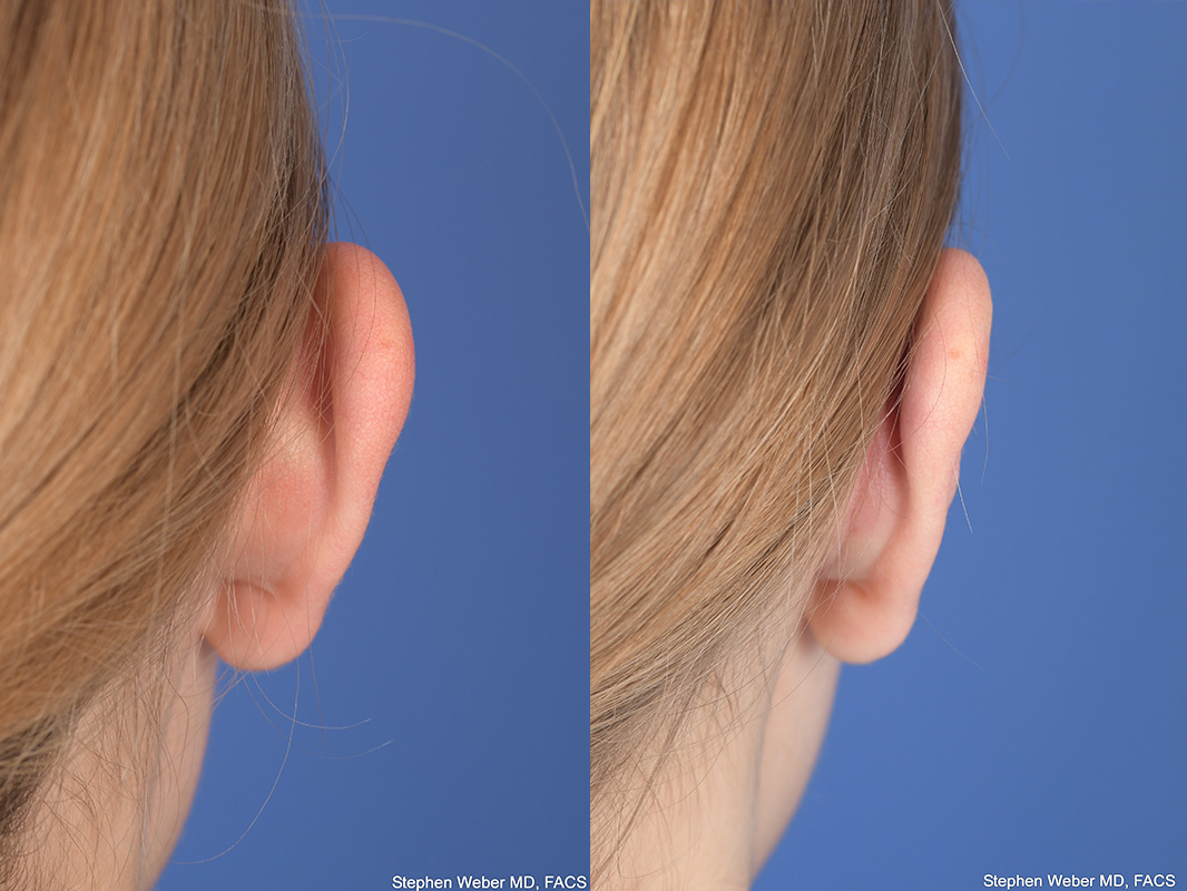 Otoplasty Before and After | Weber Facial Plastic Surgery