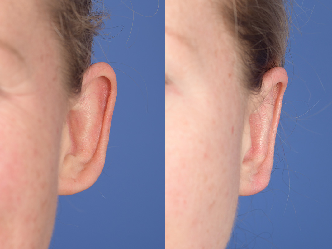 Otoplasty Before and After | Weber Facial Plastic Surgery