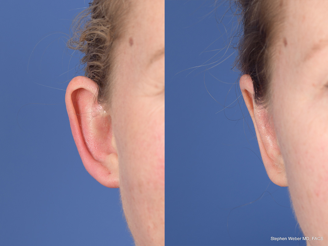 Otoplasty Before and After | Weber Facial Plastic Surgery