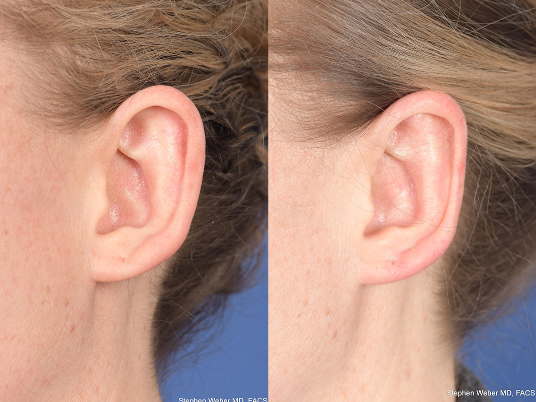 Otoplasty Before and After | Weber Facial Plastic Surgery