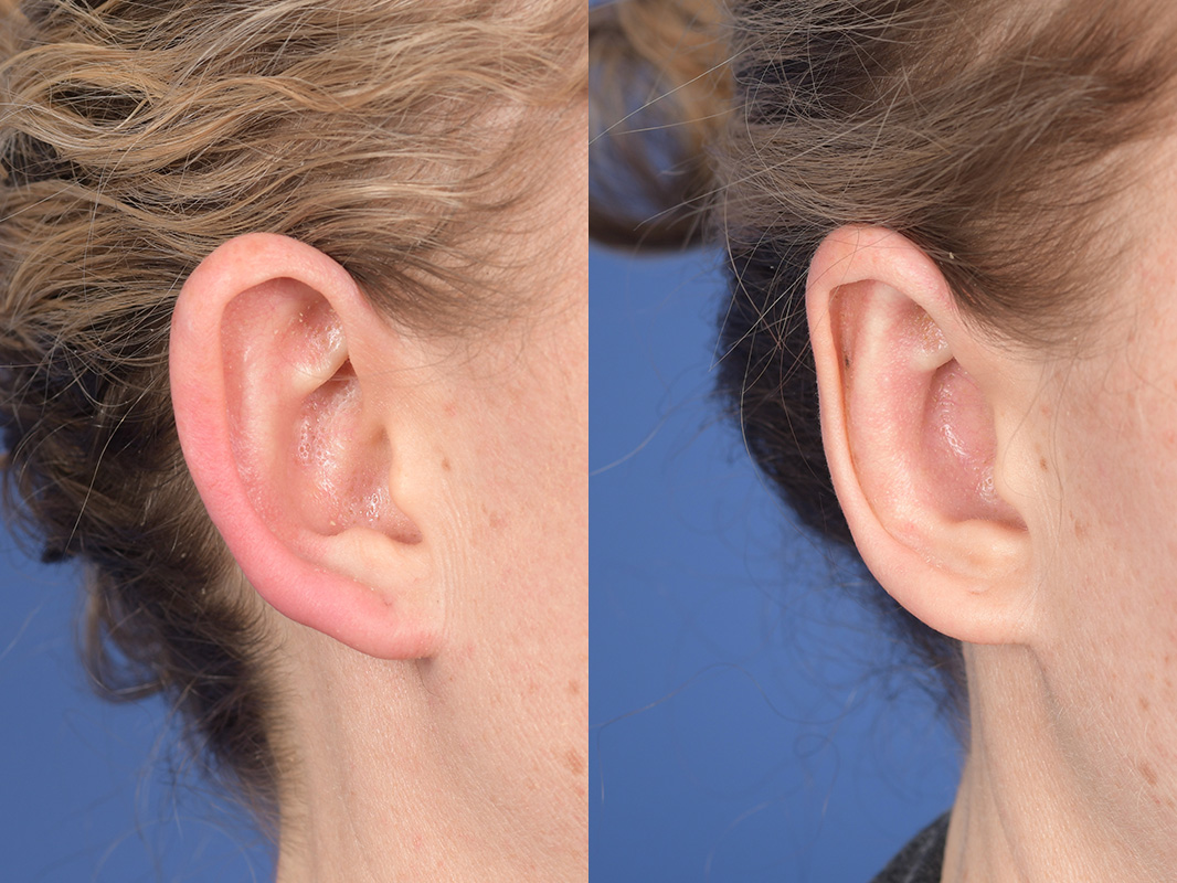 Otoplasty Before and After | Weber Facial Plastic Surgery