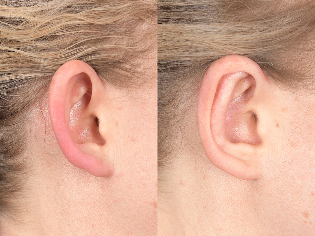 Otoplasty Before and After | Weber Facial Plastic Surgery