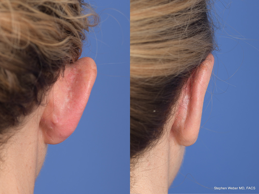 Otoplasty Before and After | Weber Facial Plastic Surgery