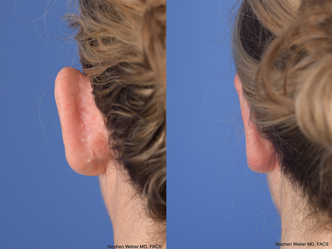 Otoplasty Before and After | Weber Facial Plastic Surgery