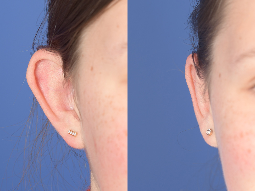Otoplasty Before and After | Weber Facial Plastic Surgery