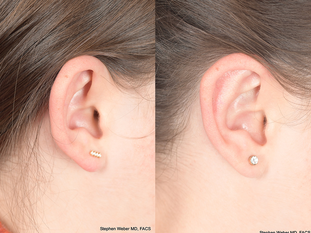 Otoplasty Before and After | Weber Facial Plastic Surgery