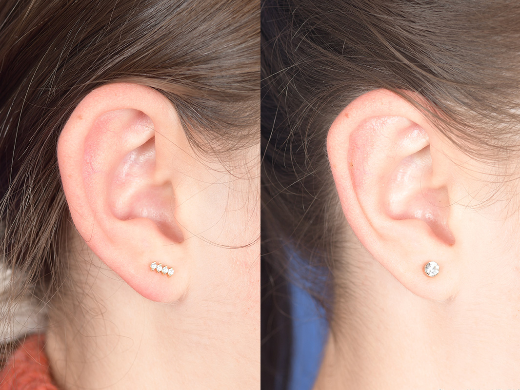 Otoplasty Before and After | Weber Facial Plastic Surgery