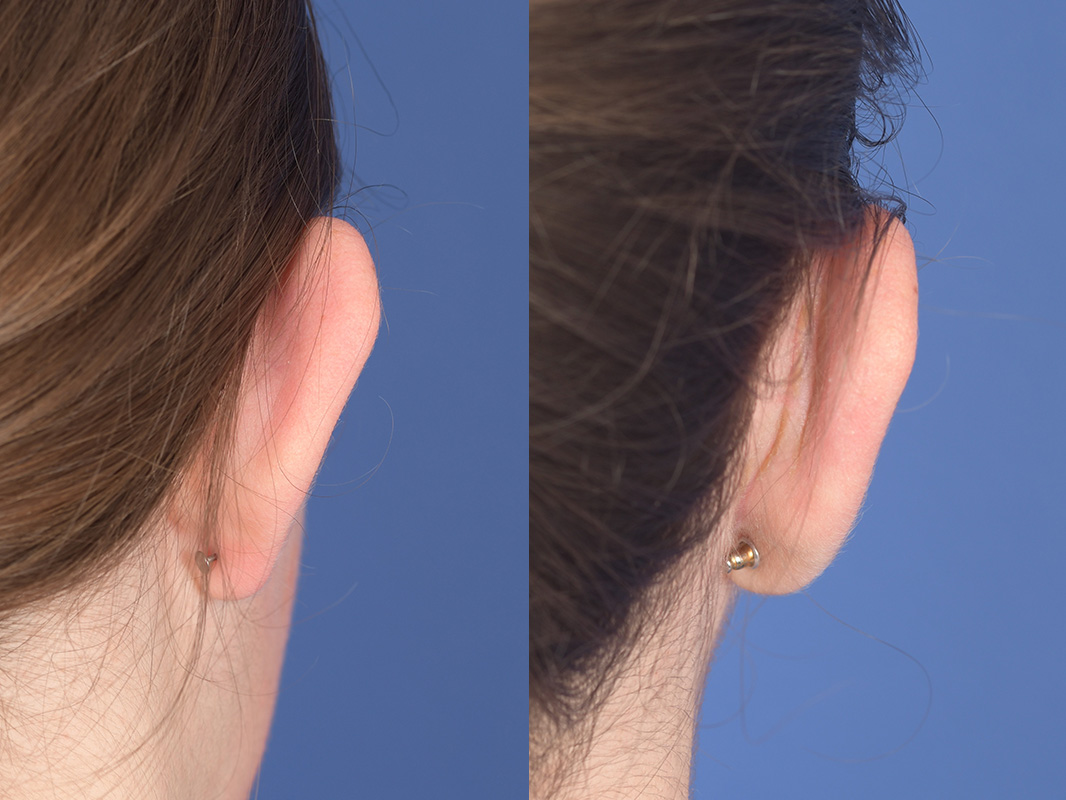Otoplasty Before and After | Weber Facial Plastic Surgery