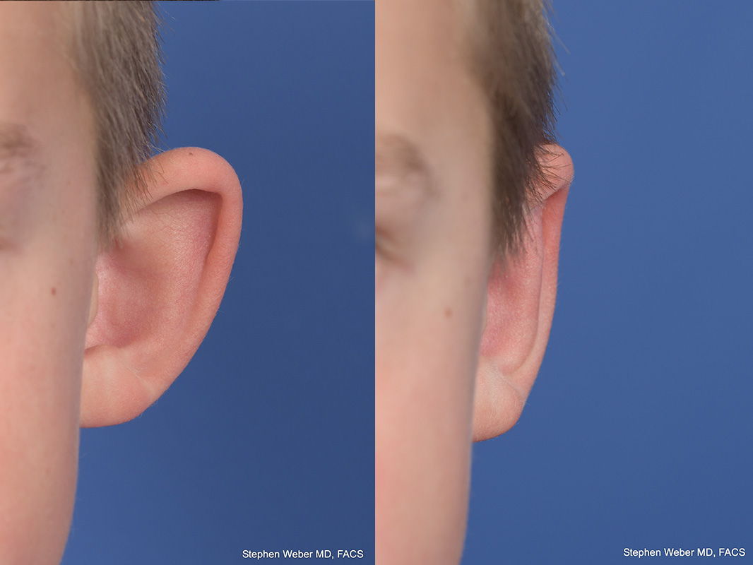 Otoplasty Before and After | Weber Facial Plastic Surgery