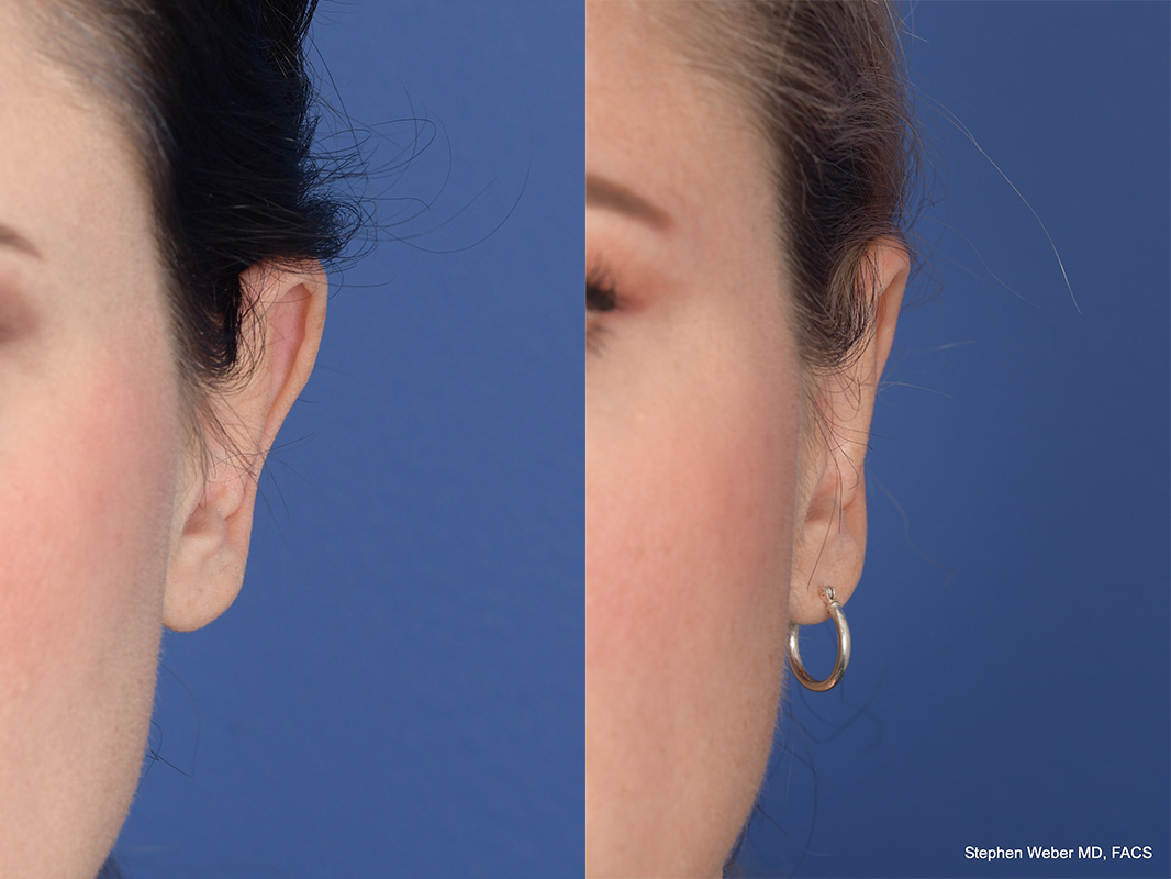 Otoplasty Before and After | Weber Facial Plastic Surgery