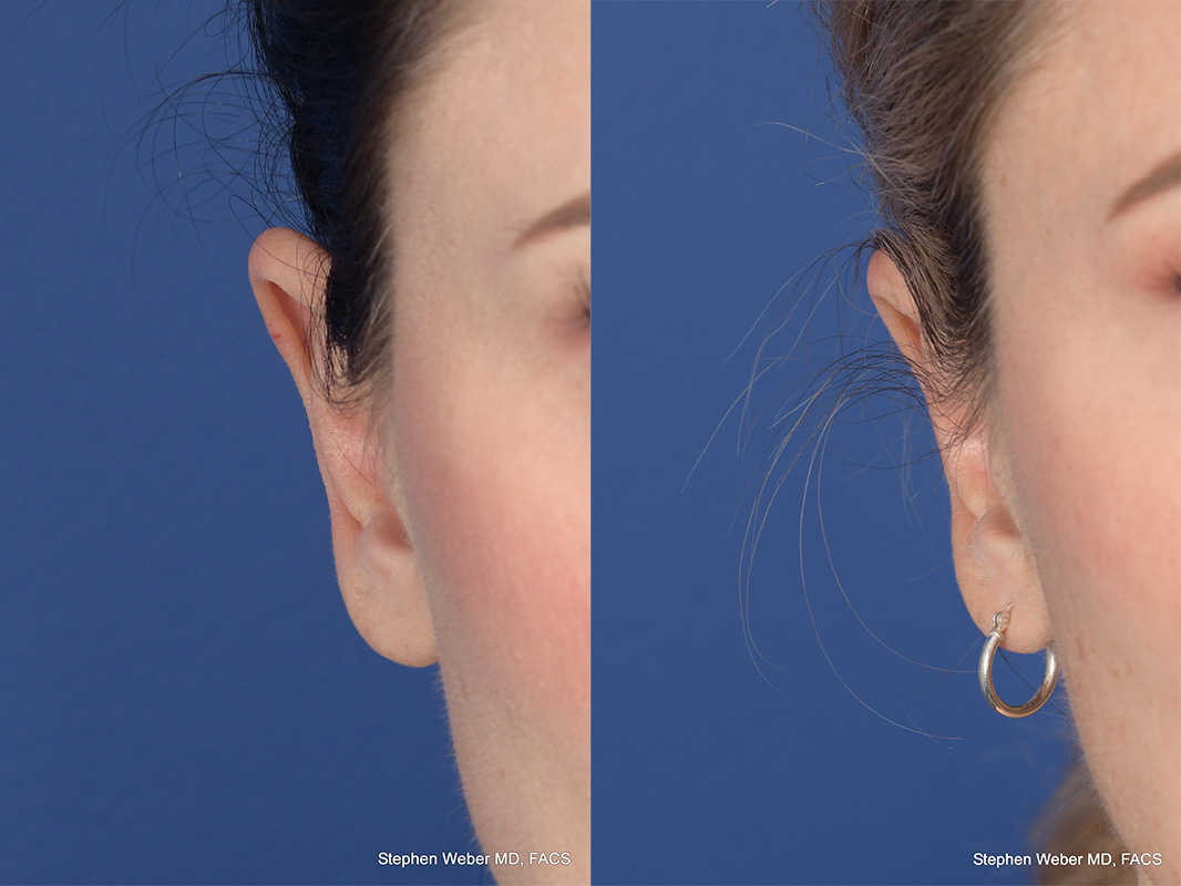 Otoplasty Before and After | Weber Facial Plastic Surgery