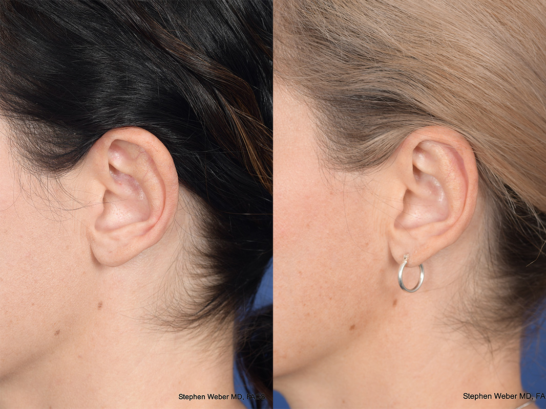 Otoplasty Before and After | Weber Facial Plastic Surgery