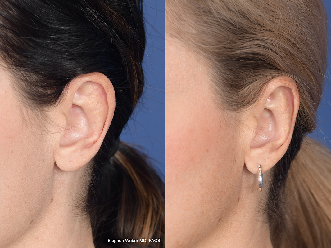 Otoplasty Before and After | Weber Facial Plastic Surgery