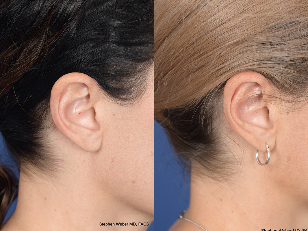 Otoplasty Before and After | Weber Facial Plastic Surgery