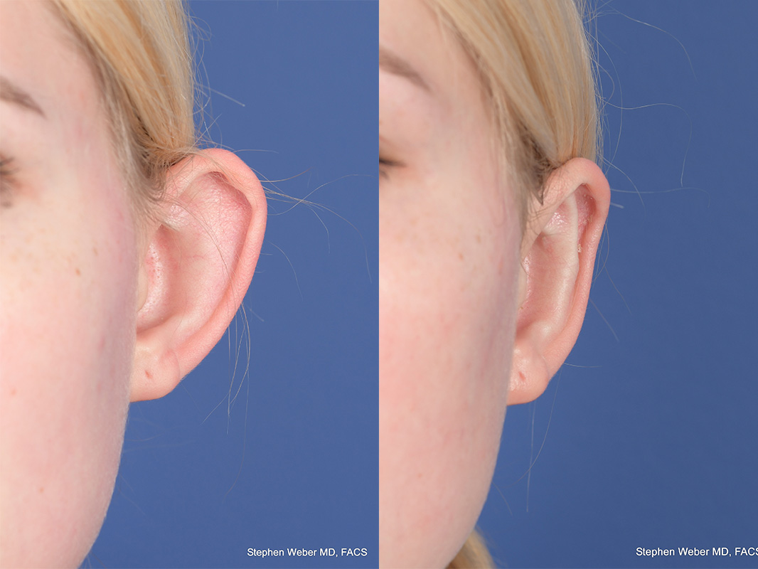 Otoplasty Before and After | Weber Facial Plastic Surgery
