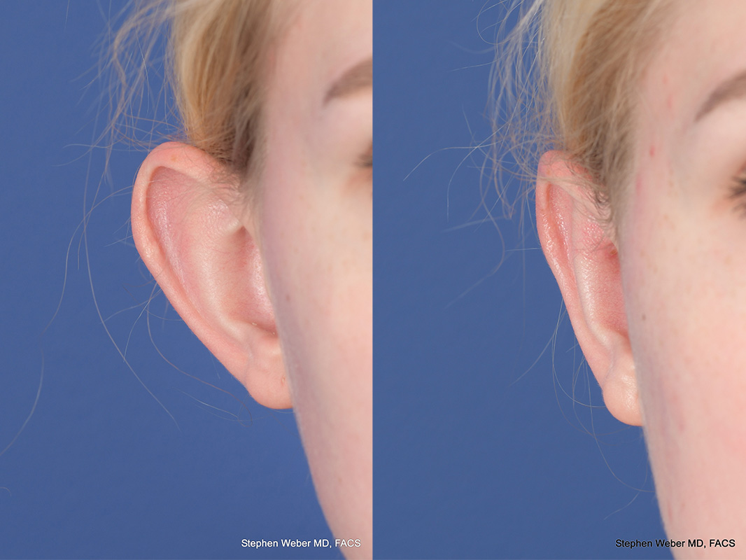 Otoplasty Before and After | Weber Facial Plastic Surgery