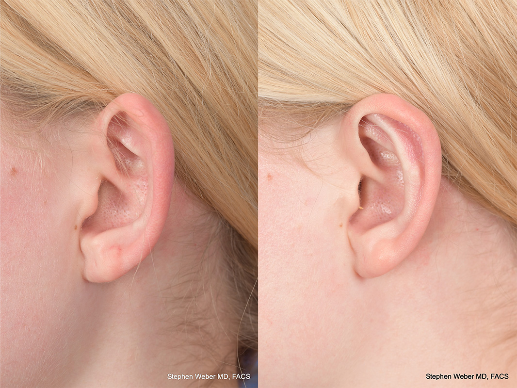 Otoplasty Before and After | Weber Facial Plastic Surgery