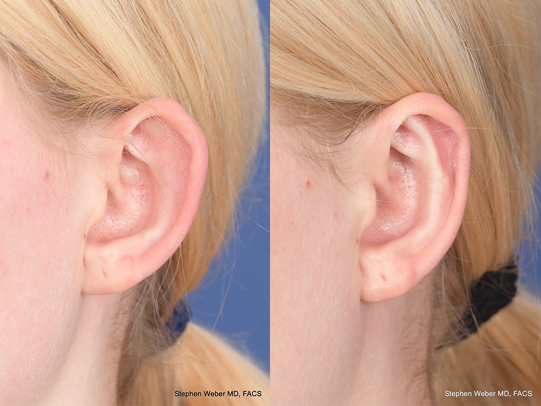 Otoplasty Before and After | Weber Facial Plastic Surgery