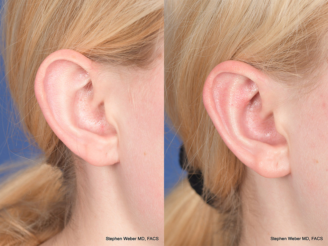 Otoplasty Before and After | Weber Facial Plastic Surgery
