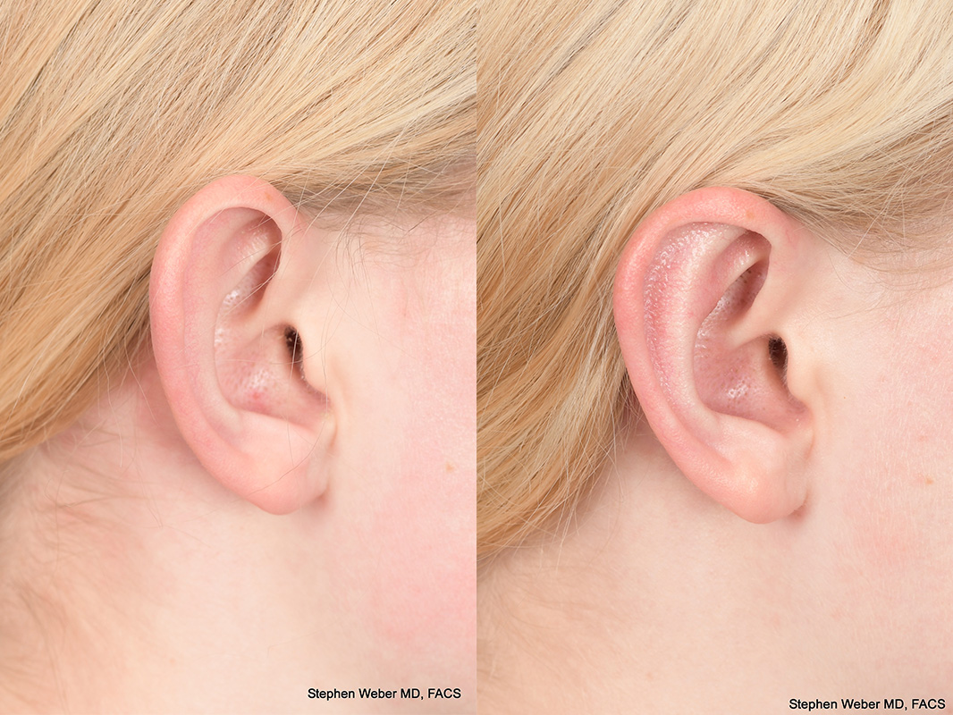 Otoplasty Before and After | Weber Facial Plastic Surgery