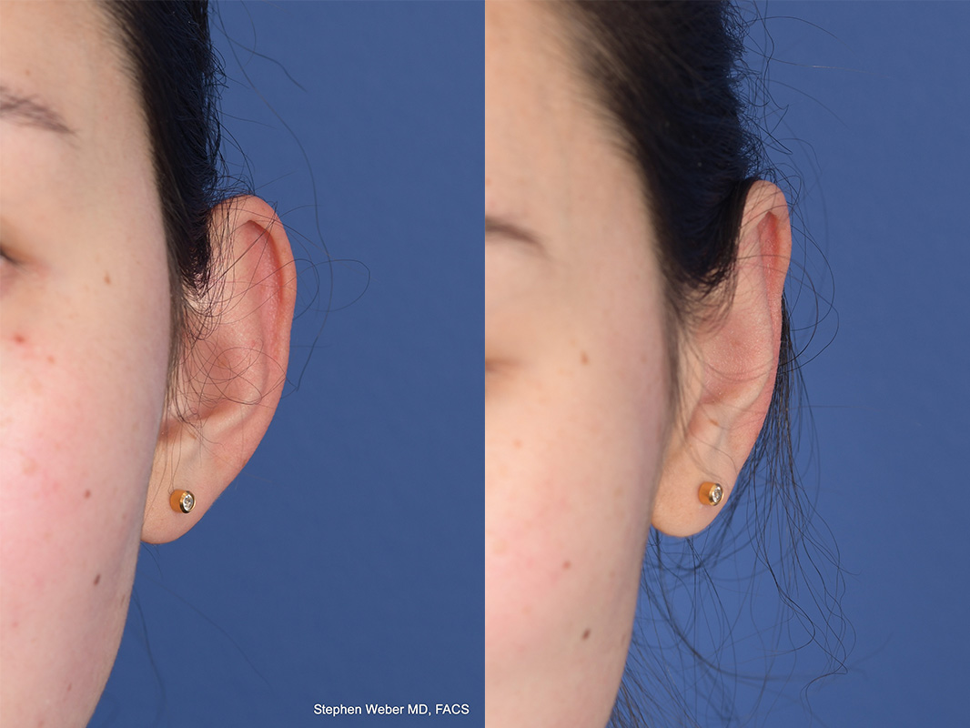 Otoplasty Before and After | Weber Facial Plastic Surgery