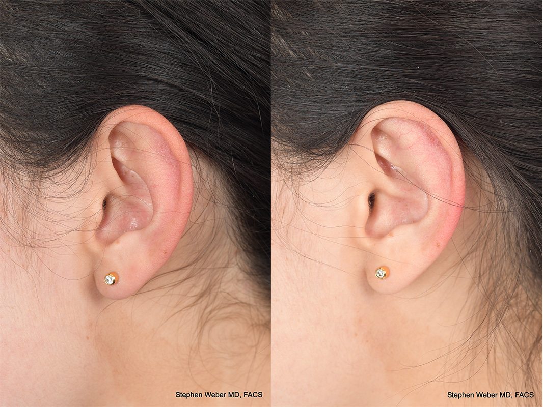 Otoplasty Before and After | Weber Facial Plastic Surgery