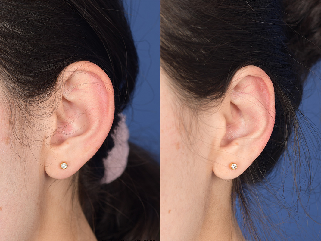 Otoplasty Before and After | Weber Facial Plastic Surgery