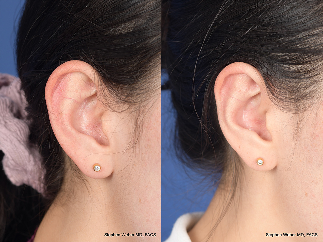 Otoplasty Before and After | Weber Facial Plastic Surgery