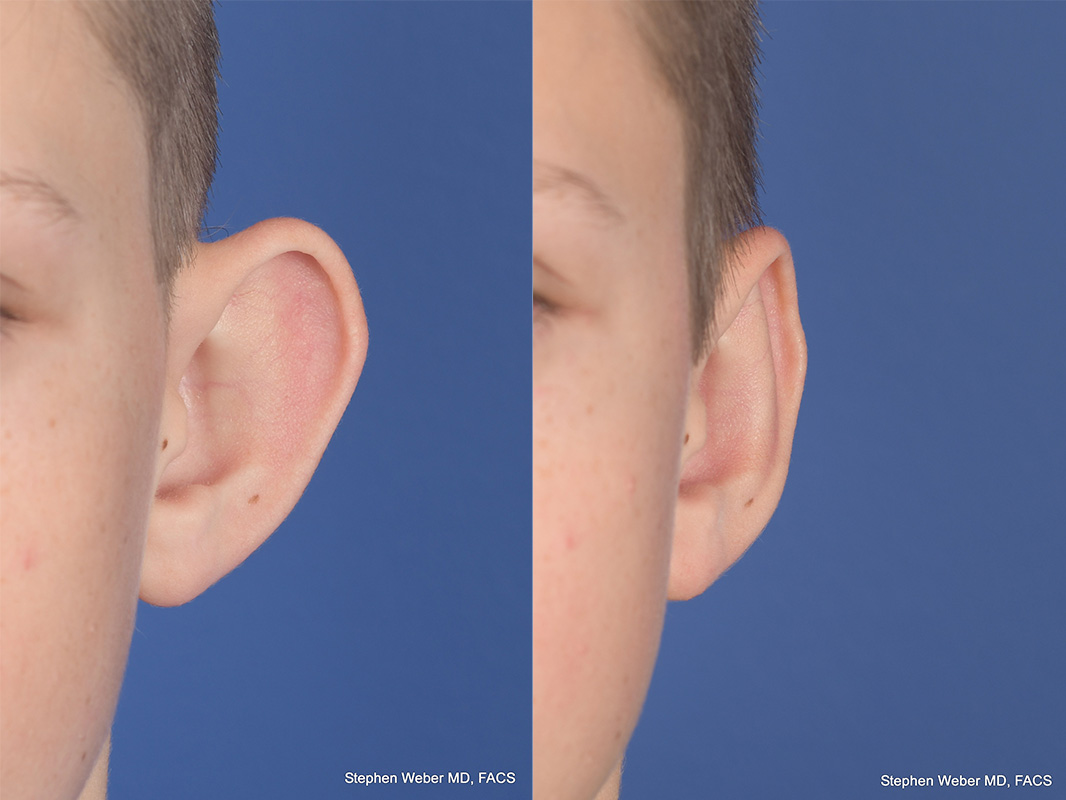 Otoplasty Before and After | Weber Facial Plastic Surgery